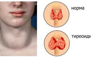 Аутоиммунный тиреоидит щитовидной железы – симптомы, лечение