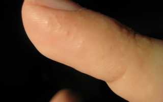 Маленькие водянистые пузырьки на пальцах рук