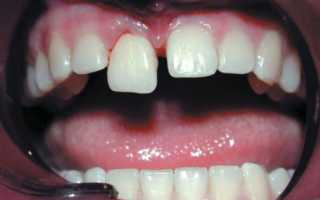 Первая помощь при вывихе зуба и лечение