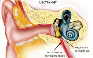 Евстахиит – симптомы и лечение воспаления евстахиевой трубы