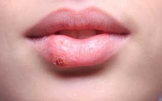 Герпес на губах: как и чем лечить в домашних условиях