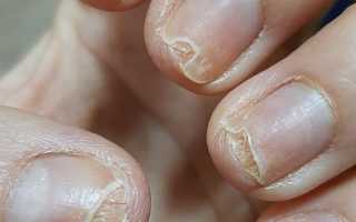 Грибок ногтей на руках – средства лечения, фото начальной стадии
