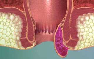 Симптомы и лечение тромбоза наружного геморроидального узла