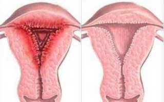 Эндометрит матки – симптомы и лечение, хронический