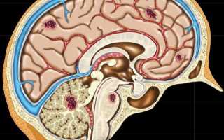 Симптомы и лечение каверномы головного мозга