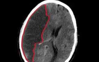 Симптомы и лечение ишемического инсульта головного мозга