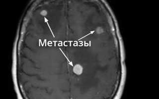 Метастазы в головном мозге