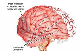 Дисциркуляторная энцефалопатия 1, 2, 3 степени, лечение мозга, МКБ-10