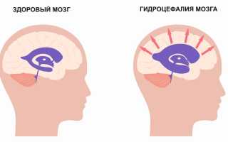 Смешанная гидроцефалия головного мозга