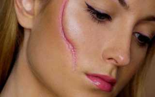Методы удаления шрамов на лице и теле