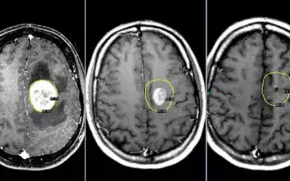 Сравнительная характеристика процедуры МРТ головного мозга и КТ