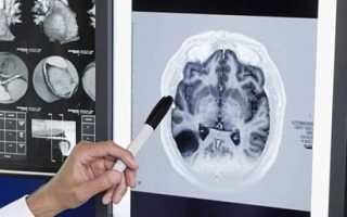 Виды и лечение энцефалопатии головного мозга у детей