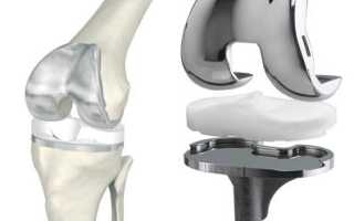 Эндопротезирование коленного сустава – операция и реабилитация после