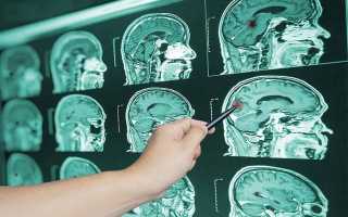 Причины и последствия отека головного мозга