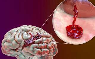 Последствия и причины кровоизлияния в головной мозг